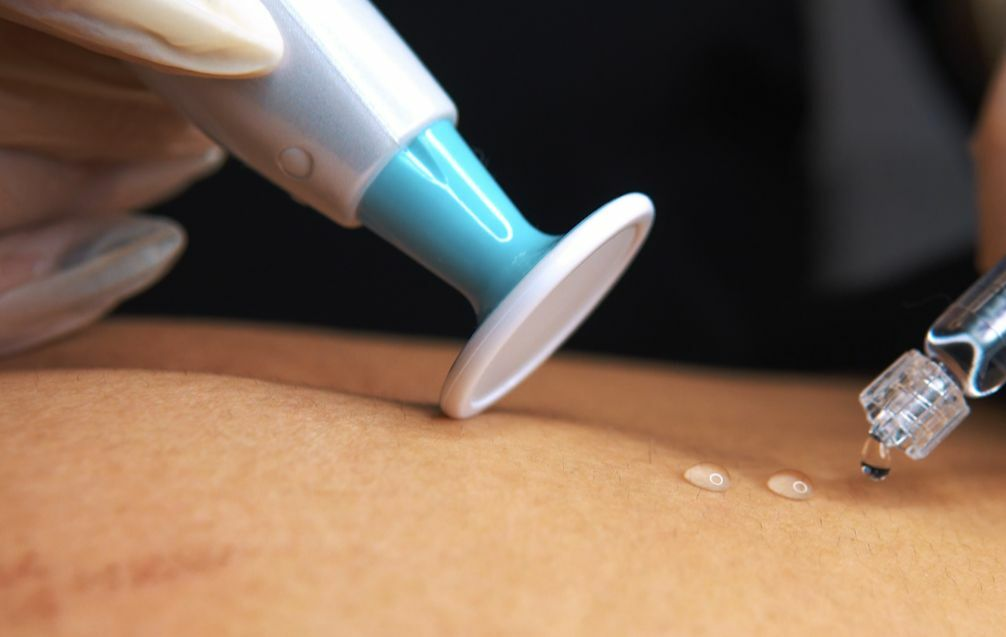  PLASMA ozono+frío Tratamiento Rejuvenecdor efecto Lifting