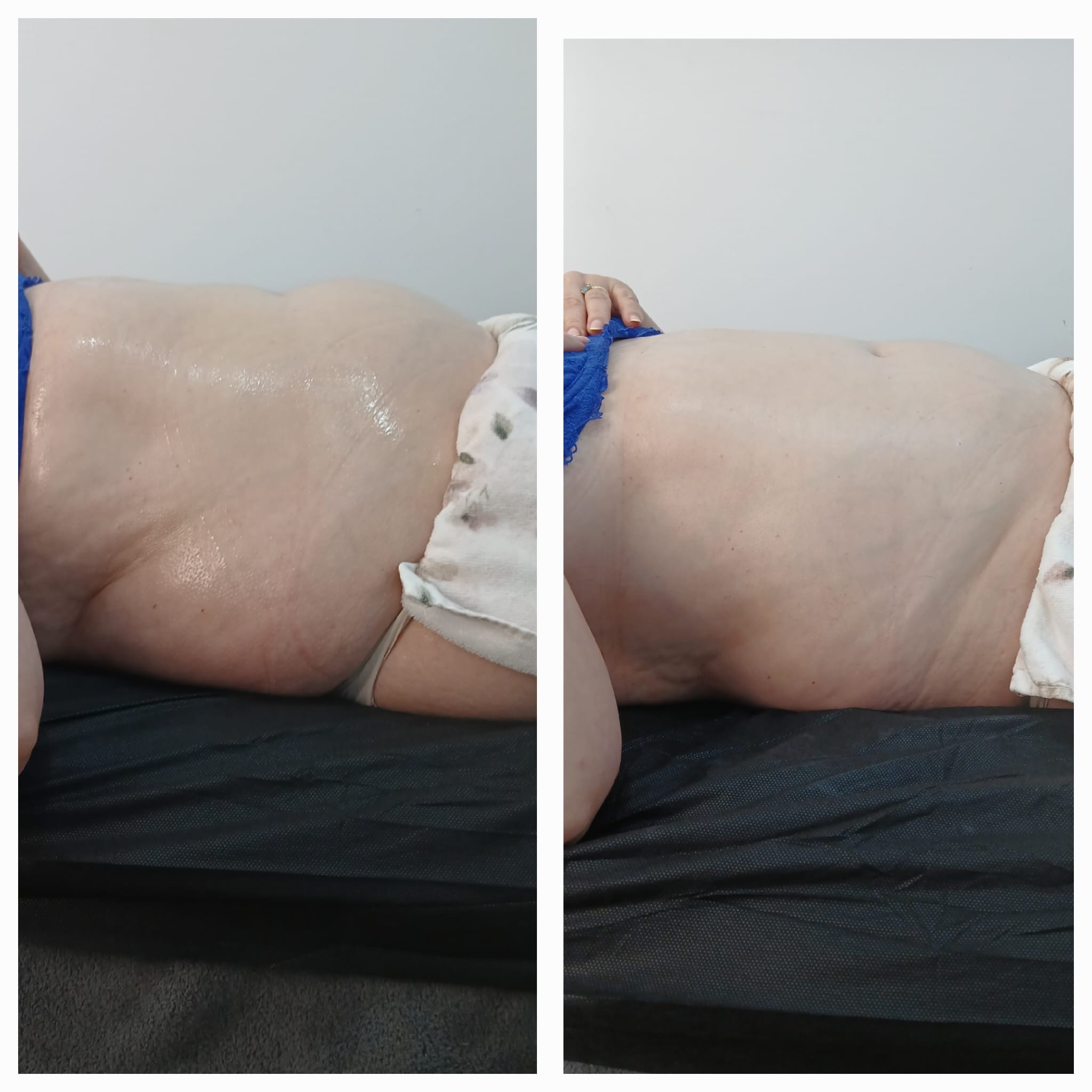  MASAJE BRASILEÑO CON REDUVEL