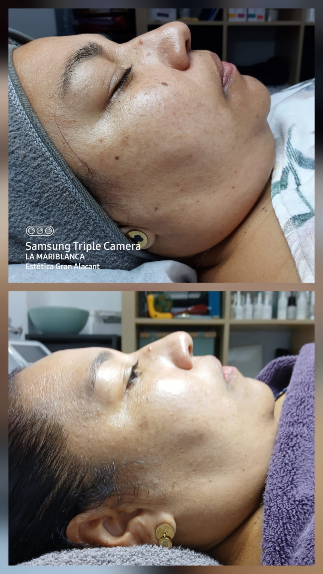  Tratamiento Despigmentante