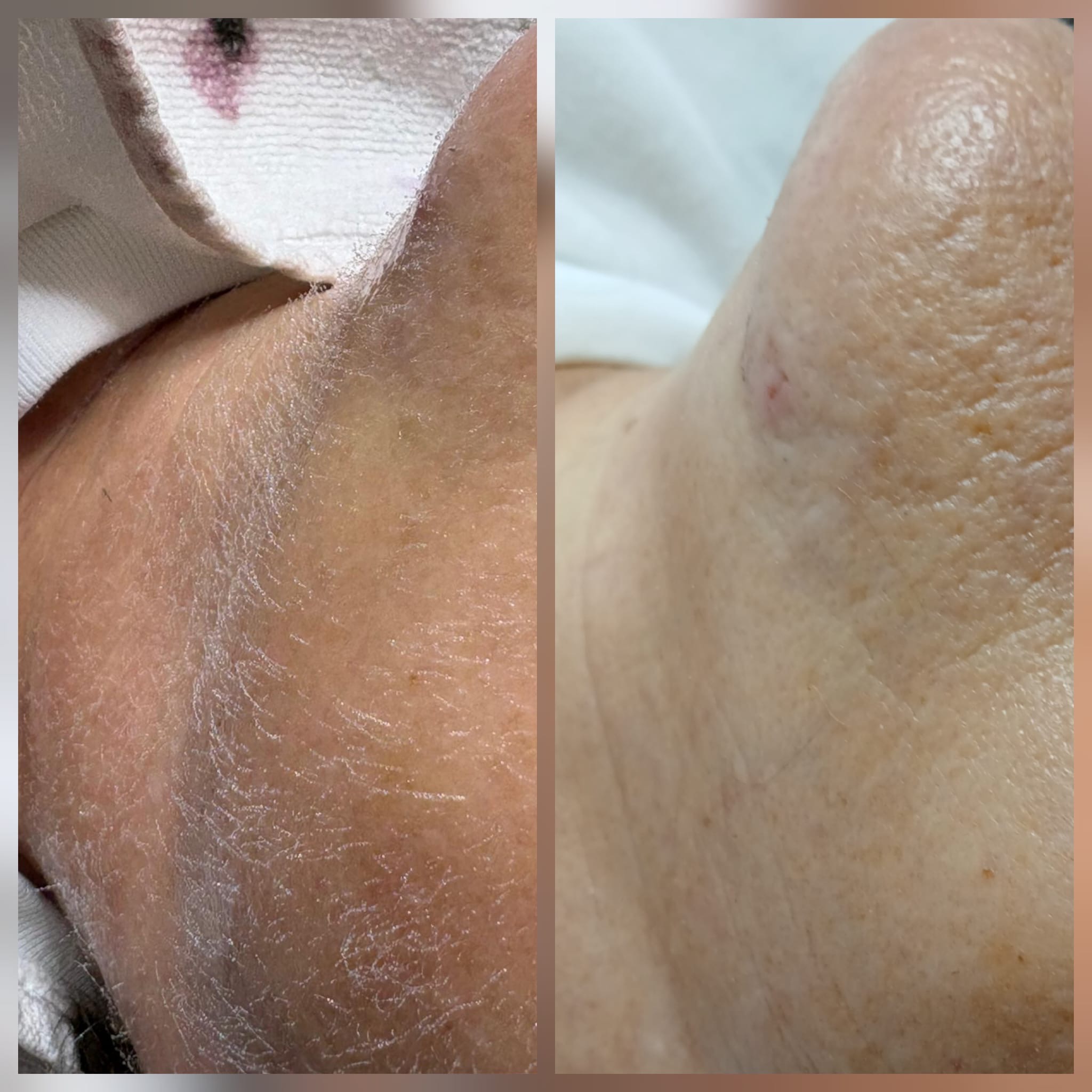  DERMAPLANING